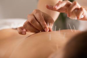 Acupuncture for healing and prevention