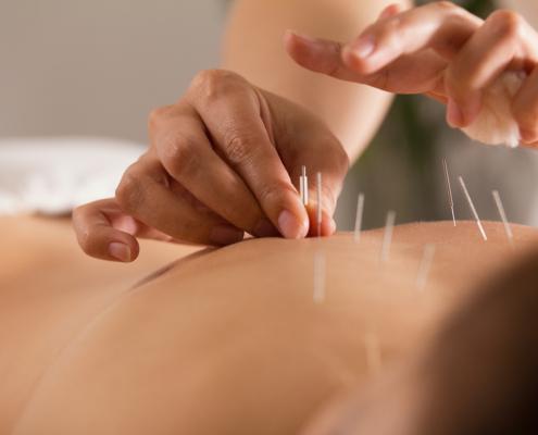 Acupuncture for healing and prevention